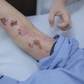 Bất ngờ bị sét đánh trên đường về nhà, người phụ nữ bỏng nặng
