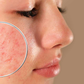 Da dầu mụn, mụn viêm sưng nên dùng gì? Gợi ý routine chuẩn y khoa từ Trioderma