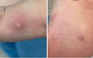 Trường hợp nào được xem là nghi ngờ mắc bệnh đậu mùa khỉ?