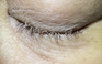 Rận ký sinh, đẻ trứng trên mi mắt bệnh nhân