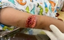 Bé gái 7 tuổi bị chó cắn, mất nhiều phần thịt ở cánh tay